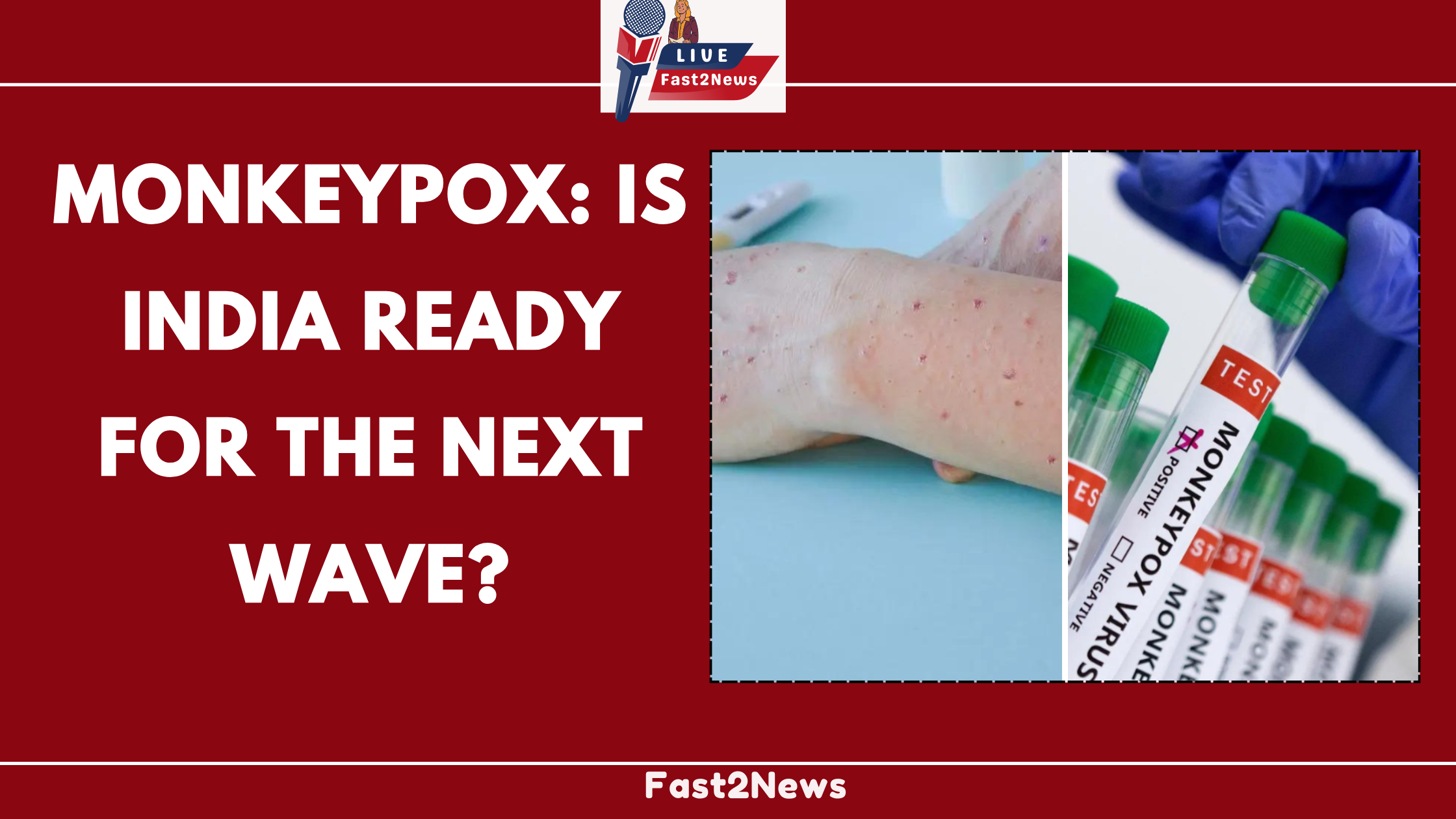 monkeypox: Is India Ready for the Next Wave?